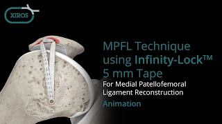 MPFL Technique using InfinityLock™ 5 mm Tape [upl. by Aisatnaf]