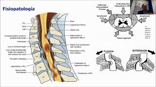 Webinar Enfermedad degenerativa cervical [upl. by Einned]