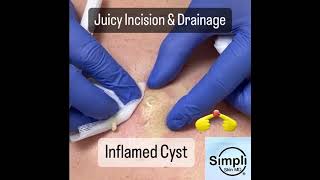 Inflamed Cyst Incision amp Drainage [upl. by Reivilo620]