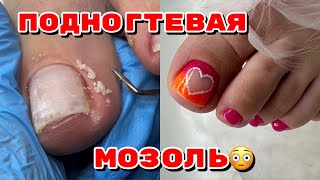 Как убрать подногтевую мозоль 🦶Педикюр 🦶дизайн ногтей на ногах [upl. by Fari]