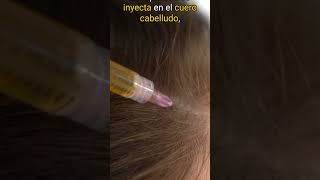 ¿Caída del cabello tu propia sangre puede ser la clave para recuperarlo esteticavicentelopez [upl. by Mackenzie]