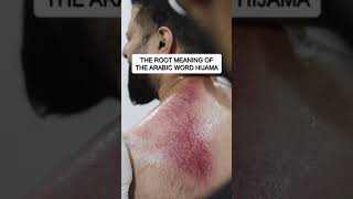 Cupping Therapy Hijama [upl. by Laemsi508]