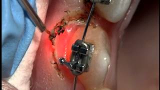 AMD Laser  Gingivectomy around brackets with Picasso [upl. by Elehcim765]