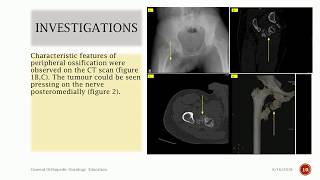 An Unusual Cause of Sciatica  Myositis ossificans [upl. by Kellyn]