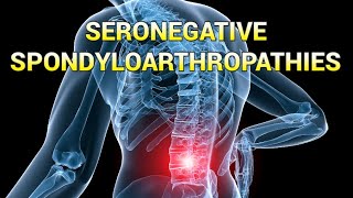 Seronegative Spondyloarthropathies updated 2023  CRASH Medical Review Series [upl. by Tanner]