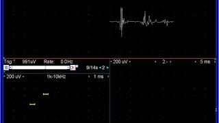 myopathic motor units deltoid [upl. by Kylie]