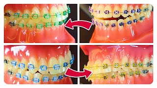 Elastics Colors on Ceramic Braces vs Metallic Braces [upl. by Kaya833]