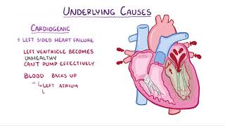 Pulmonary Edema causes symptoms diagnosis treatment pathology [upl. by Nalra340]