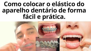 Como colocar os elásticos do aparelho dentário de forma fácil e prática [upl. by Suelo]