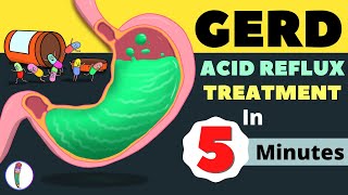 GERD Treatment  Acid Reflux Treatment  Heartburn Treatment  All You Need to Know [upl. by Krissie]