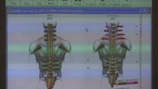 Chiropractic Adjustment Surface EMG Scans amp Spinal Alignment by Dr Madden [upl. by Butler]