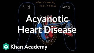 What is acyanotic heart disease  Circulatory System and Disease  NCLEXRN  Khan Academy [upl. by Fernandes]