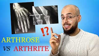 Arthrose et arthrite  les différences causes symptômes traitements [upl. by Ahtilat164]