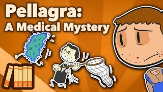 Pellagra  A Medical Mystery  Extra History [upl. by Assirrac666]