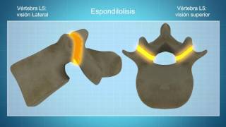 Espondilolisis y Espondilolistesis [upl. by Rahab121]