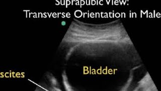 ultrasound ascitic with mesenteric cyst pid pod लड़का लड़की भी कर सकती ह अल्ट्रासाउंड। [upl. by Ayot860]