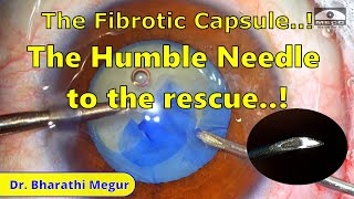 The Humble Needle to the rescue Difficult Rhexis in a Hypermature Cataract  Dr Bharathi Megur [upl. by Alenas]