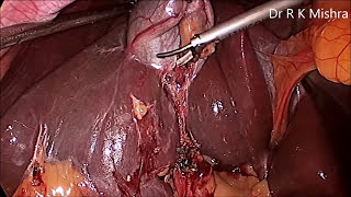 Gallbladder Stone Surgery [upl. by Ataeb]