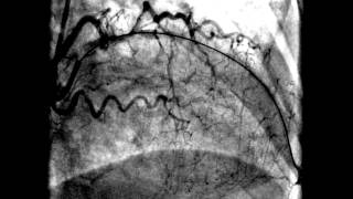 Acute anteroseptal myocardial infarction [upl. by Reiner]