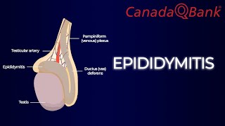 Epididymitis [upl. by Manuela]