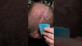 Dandruff scratching headscratching asmrscalpcheck scalpscratching [upl. by Gnod]