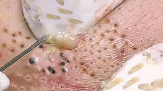 NEW Pimple Popping Compilation  Blackheads removal  Pimple removal vids of 2021 [upl. by Teador287]