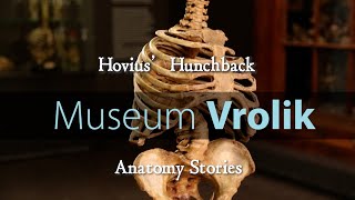 Museum Vrolik  Anatomy Stories 2 Hovius Hunchback [upl. by Ettenim974]