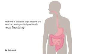 Anatomy of Loop Ileostomy and Pouch Construction [upl. by Ola]