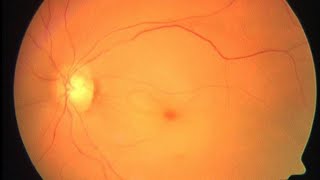 MNEMONIC for Causes of Cherry Red Spot on Retina [upl. by Boru]