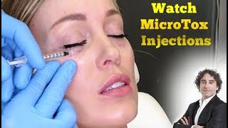 Watch MicroTox Eye InjectionsBefore and After [upl. by Aicala807]