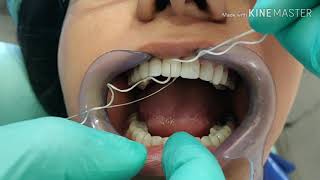 ORAL HYGIENE MAINTENANCE OF DENTAL VENEERS [upl. by Nyloj67]