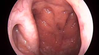 Nasopharyngoscopy nasopharynx adenoid tuba eustachius [upl. by Seebeck132]