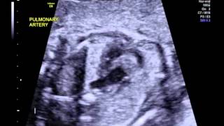 Tetralogy of Fallot with pulmonary stenosis 3 vessel view [upl. by Early]