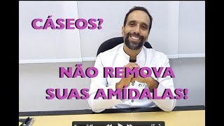 Você tem CÁSEOS Não REMOVA suas AMÍDALAS [upl. by Ettelocin692]