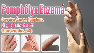 Pompholyx eczema causes symptoms diagnosis treatment home remedies FAQ  Dyshidrotic eczema [upl. by Williamson]