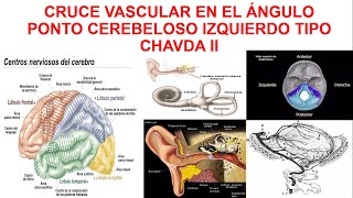 CRUCE VASCULAR EN EL ÁNGULO PONTO CEREBELOSO IZQUIERDO TIPO CHAVDA II [upl. by Ilrebma718]