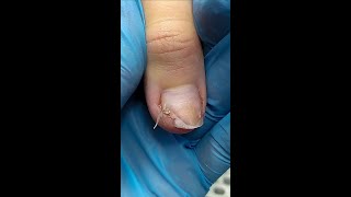 ONYCHOLYSIS OF NAILS AGAIN🙈 3 MONTHS OF coating😱 Causes of onycholysis what to do about it shorts [upl. by Eniliuqcaj]