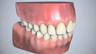 Inman Aligner Standard Animation [upl. by Ahseined]