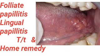 Tongue के Side मे bump है कही मुझे cancer तो नहीFolliate papillitisLingual papillitisHow to cure [upl. by Lyrradal]