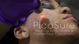 PicoSure Laser for Acne Scars amp Pigmentation [upl. by Moonier]