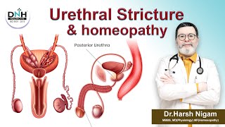 Urethral stricture amp homeopathy  Urethral Stricture [upl. by Lanrev]