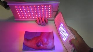 Medilight  Lichttherapie gegen chronische Wunden [upl. by Parker]