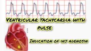 ventricular tachycardia with pulse [upl. by Rehpotsihrc]