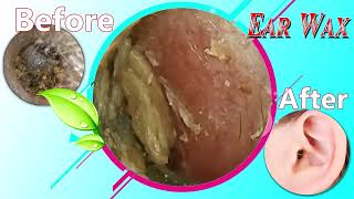 Ear Wax Removal Myths Debunked What You Need to Know 018 [upl. by Merola181]