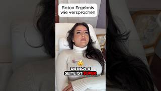 Botox Zornesfalte 5 Wochen danach aesthetix filler düsseldorf drgü doctor aesthetic botox [upl. by Phipps]