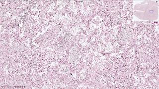 Pneumocystis Jirovecii Pneumonia  Histopathology [upl. by Anoval]