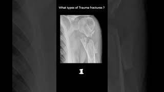 Comminuted fracture example  Humerus 21 Trauma Xray Comminuted fractures radiologychannel007 [upl. by Chura]