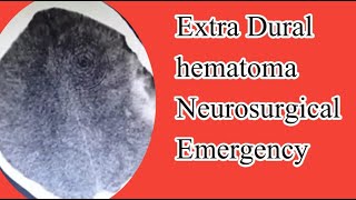 Extradural hematoma [upl. by Faires]