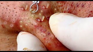 Pimple popping videos of 2021  Squeezing exploding acne Compilation [upl. by Ahsie772]