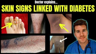 Doctor explains 12 SKIN CONDITIONS associated with DIABETES [upl. by Pironi]